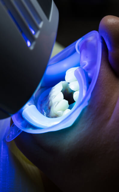 laser teeth whitening treatment