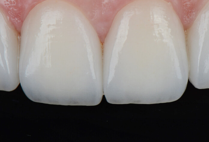 teeth after treatment