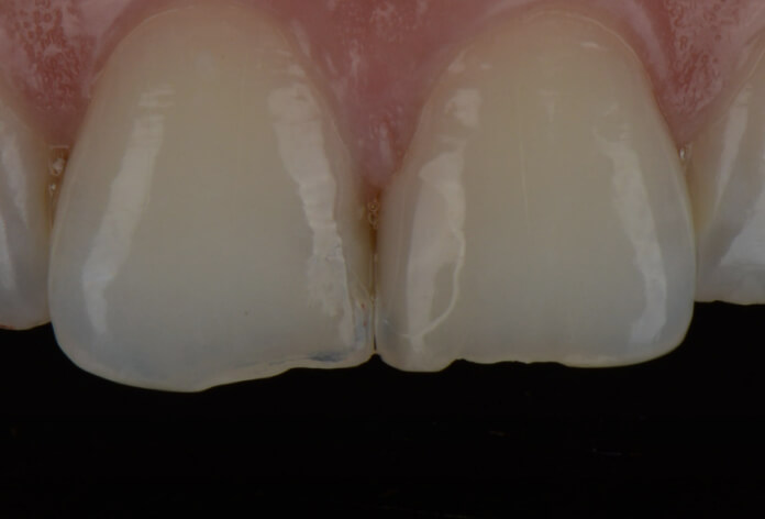 teeth before treatment